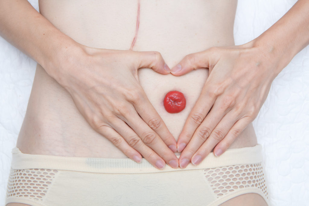 Front,View,Closeup,Stoma,And,Colostomy,With,Long,Abdominal,Surgical